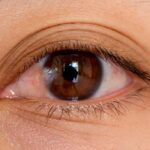 Quitting the Pterygium: Safe, Compassionate Care in Houston