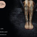 Fade tattoos faster using Picoway laser tattoo removal sessions