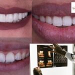 تقويم الأسنان الشفاف: ابتسامة مثالية بلا ظهور الأجهزة المعدنية