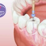 Pròtesis Dental Gines: solució natural i còmoda a Clinicadentalcristinamora