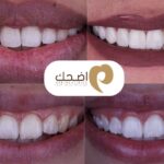 تجميل الأسنان: ابتسامة مثالية بثقة وبراعة فنية