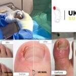 Ingrown Toenail Removal: Safe, Fast Relief with Local Anaesthetic