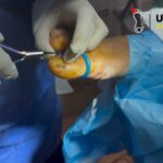 Nail Surgery Birmingham: Fast, Expert Care for Toenail Issues