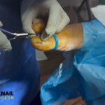 24 Hour Nail Surgery: Fast, Safe Nail Care in 1 Day